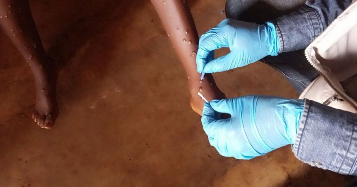 AB: Maymun çiçeği virüsünden etkilenen bölgelere 215 bin doz aşı göndereceğiz